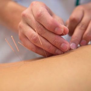 Assisted Reproduction Acupuncture