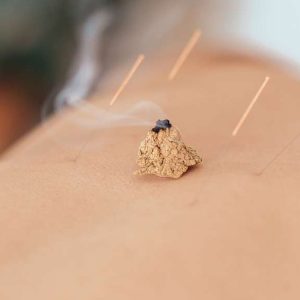 Moxibustion